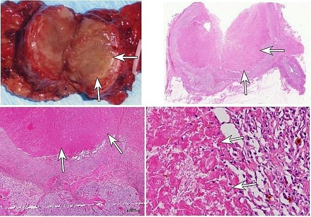 세포 사멸 - 괴사