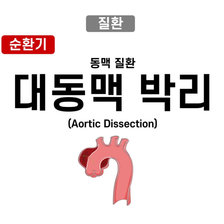 Aortic Dissection