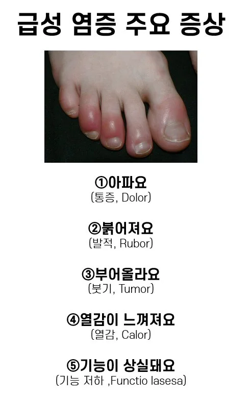 급성 염증 주요 증상