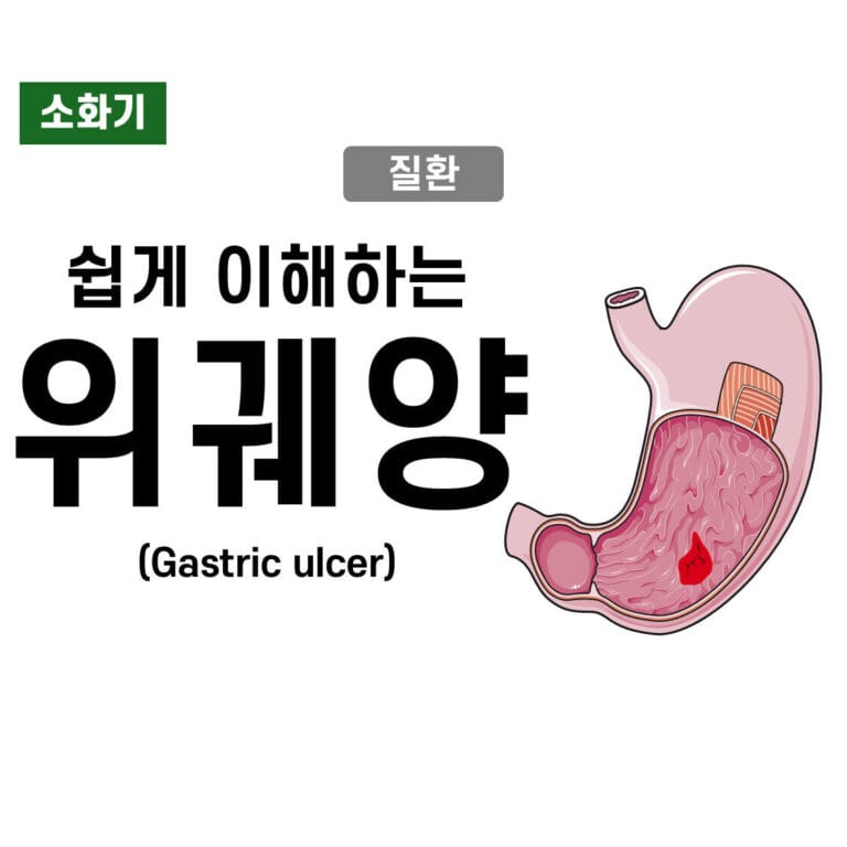 위궤양 (Gastric Ulcer)
