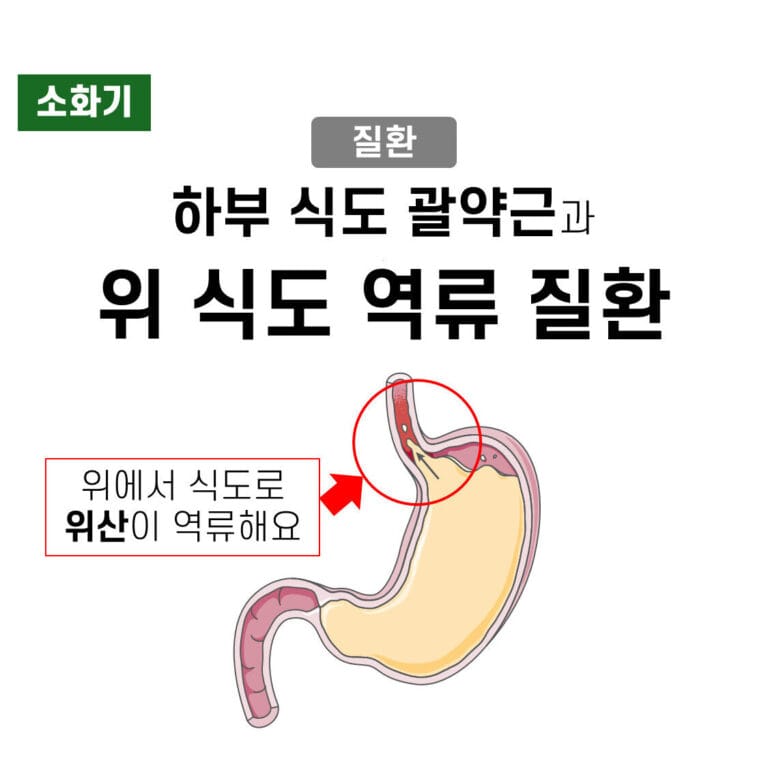 위식도역류질환 (GERD, Gastroesophageal Reflux Disease)