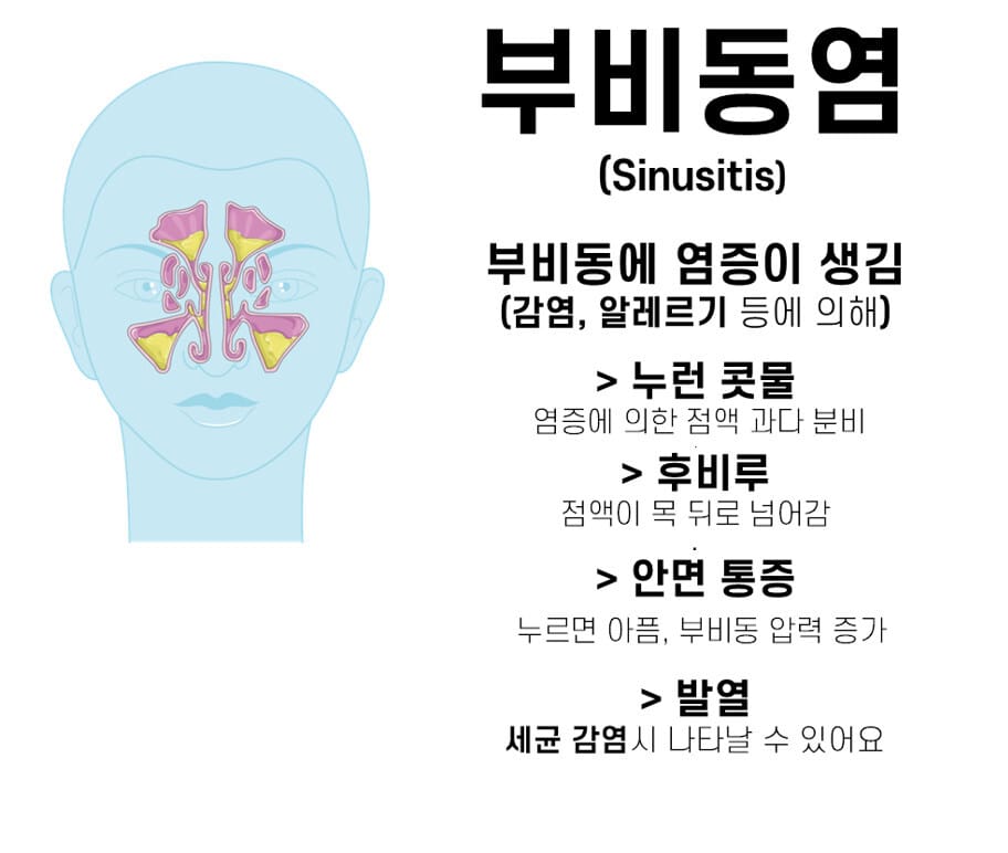 부비동염