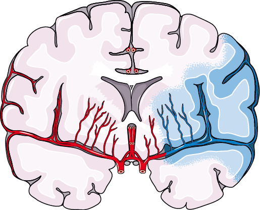 허혈성 뇌졸중, ischemic stroke