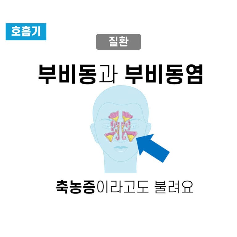 부비동염