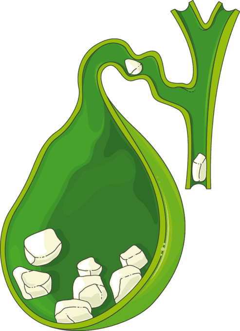 담낭염- 담석증