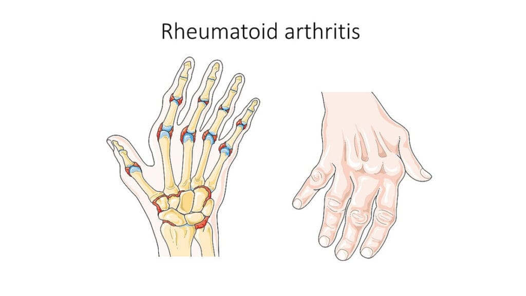 류마티스 관절염 (Rheumatoid Arthritis) | 자가면역질환