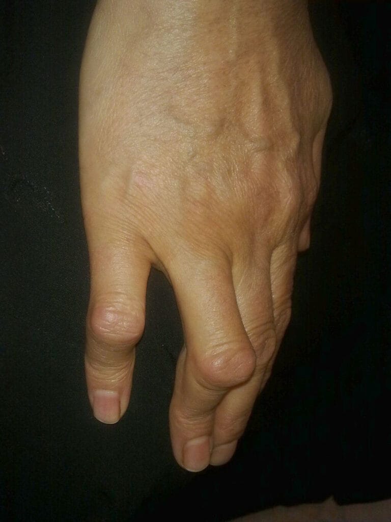 
Boutonnière deformity in two fingers of a 50 yr's women with RA .By Alborz Fallah - Own work, CC BY-SA 3.0, https://commons.wikimedia.org/w/index.php?curid=25783784