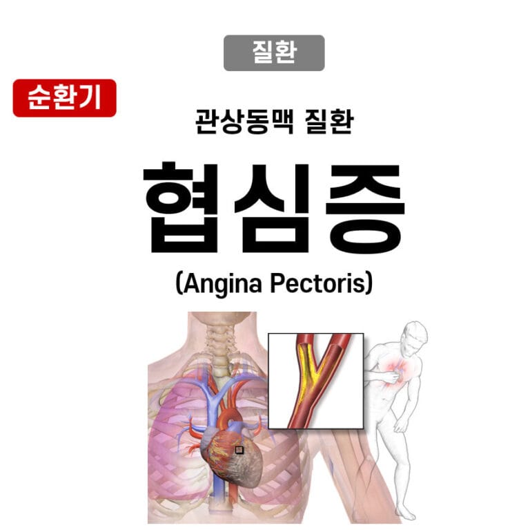 협심증 (Angina Pectoris)