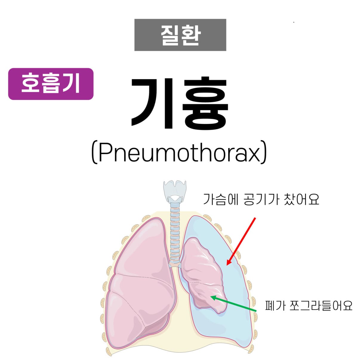 기흉 (Pneumothorax) - 의학당