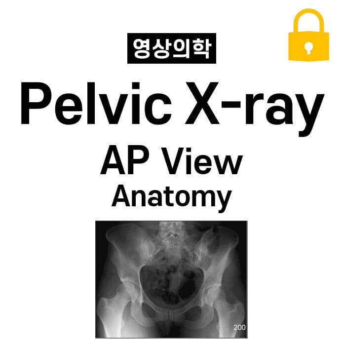 Pelvic X-ray Anatomy (AP View)