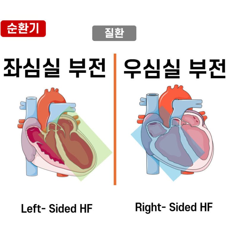 좌심부전 vs 우심부전 (Left-Sided Heart Failure vs Right-Sided Heart Failure)