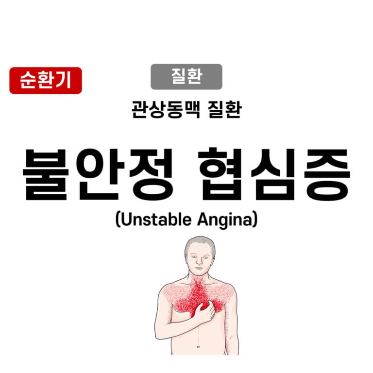 unstable angina