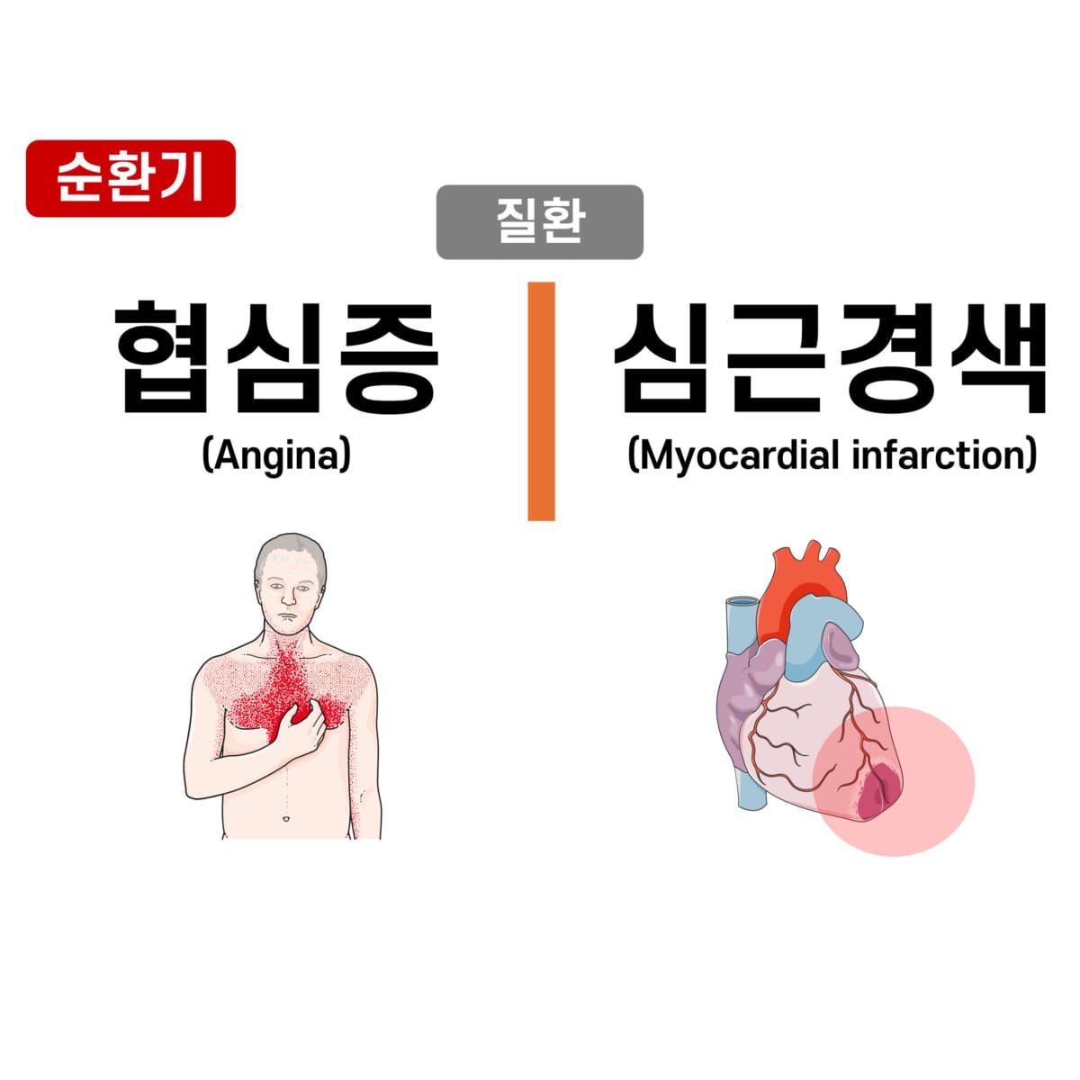 협심증 (Angina) vs 심근경색 (Myocardial Infarction)