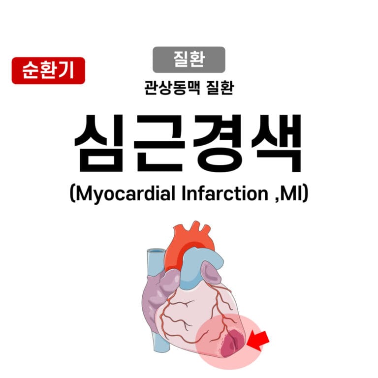 Myocardial Infarction