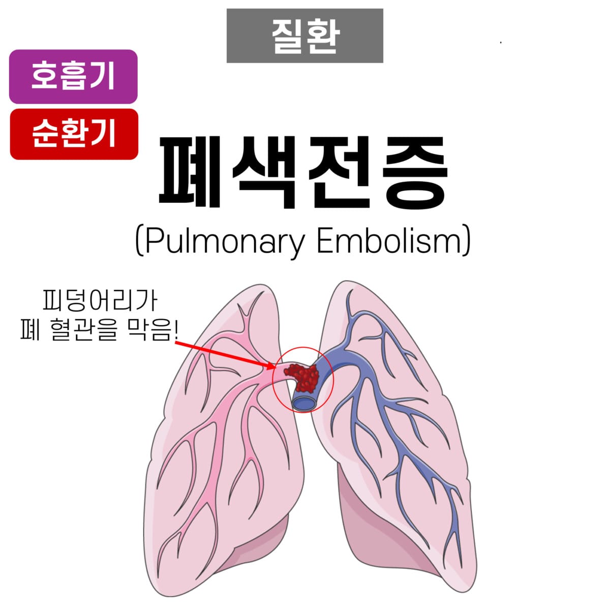 폐색전증 (Pulmonary Embolism, PE)