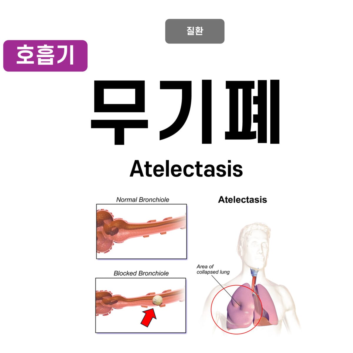 atelectasis