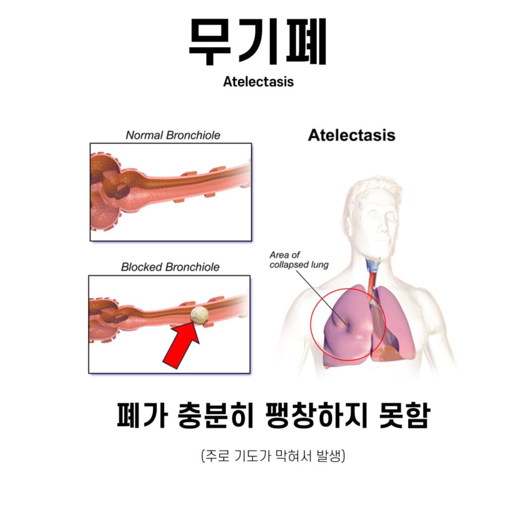atelectasis