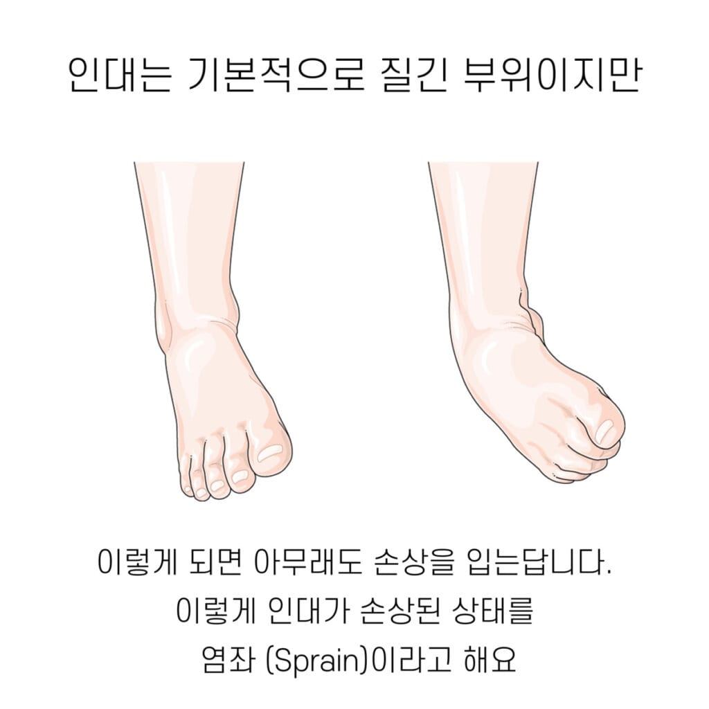 염좌 (Sprain) - 의학당