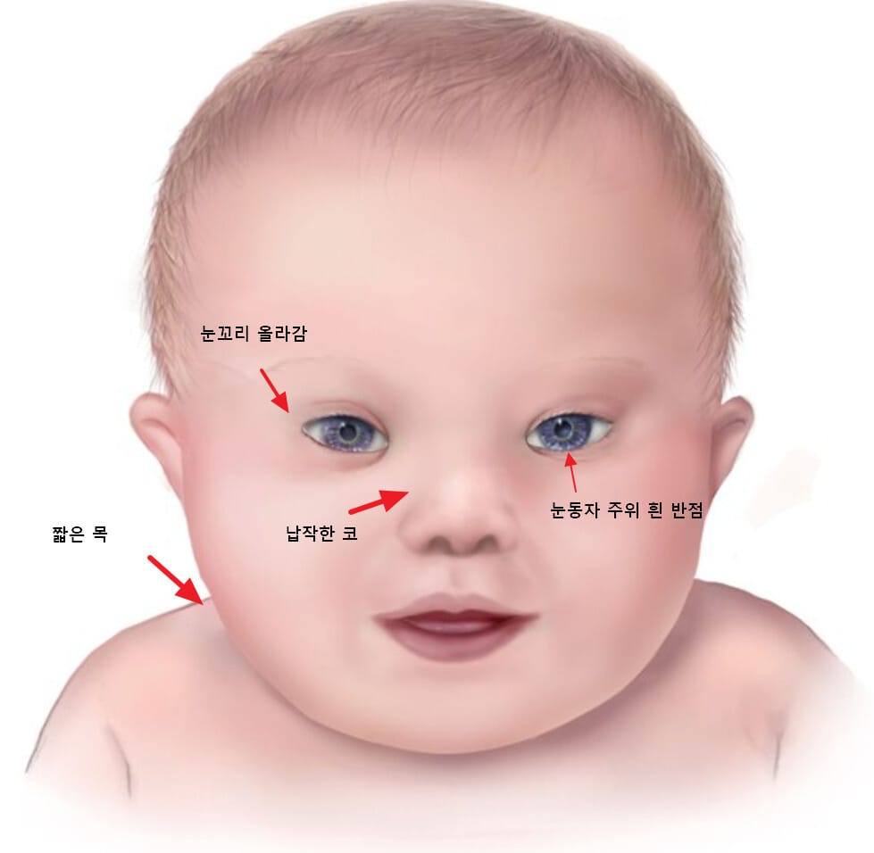 facial features of Down syndrome