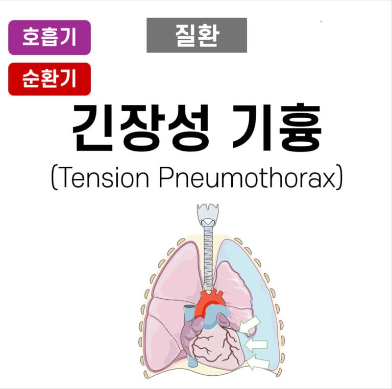 tension pneumothorax
