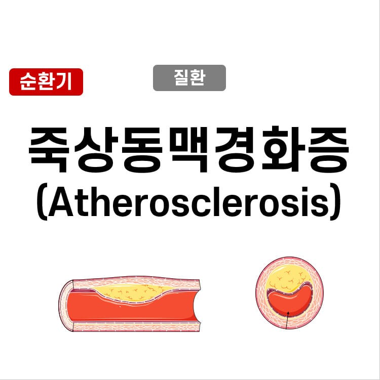 죽상동맥경화증 (Atherosclerosis)