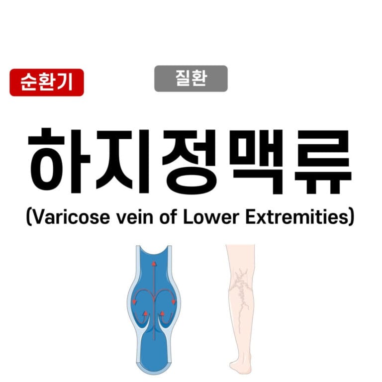 하지정맥류 (Varicose Veins of the Lower Extremities)