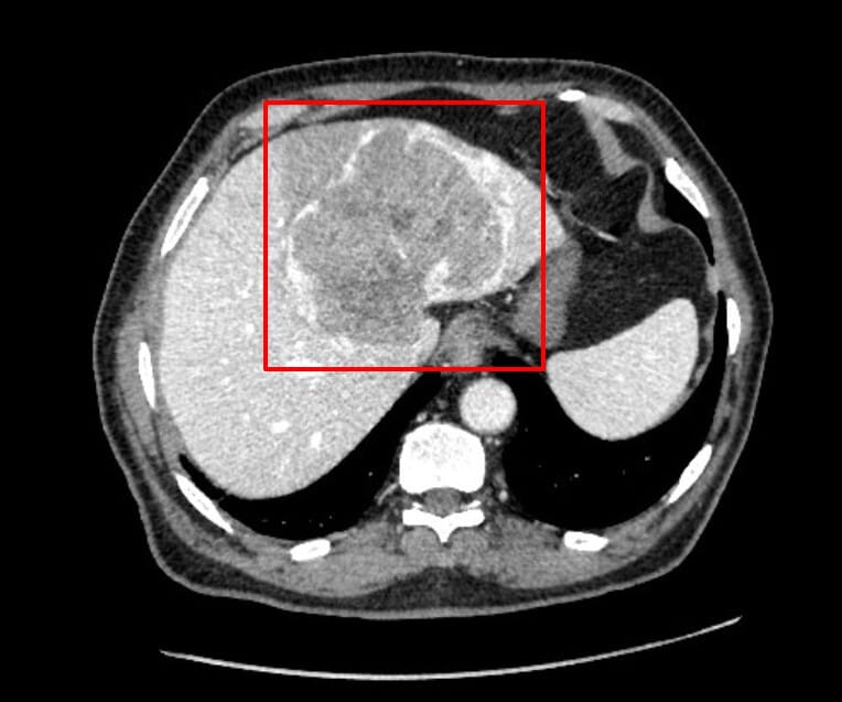 간세포암 (Hepatocellular Carcinoma, HCC)