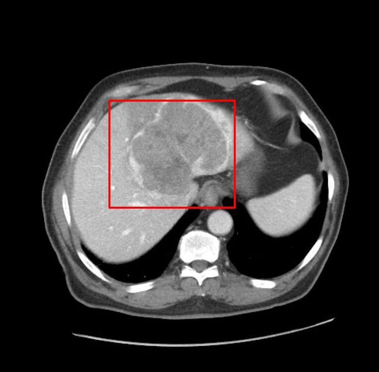 간세포암 (Hepatocellular Carcinoma, HCC)