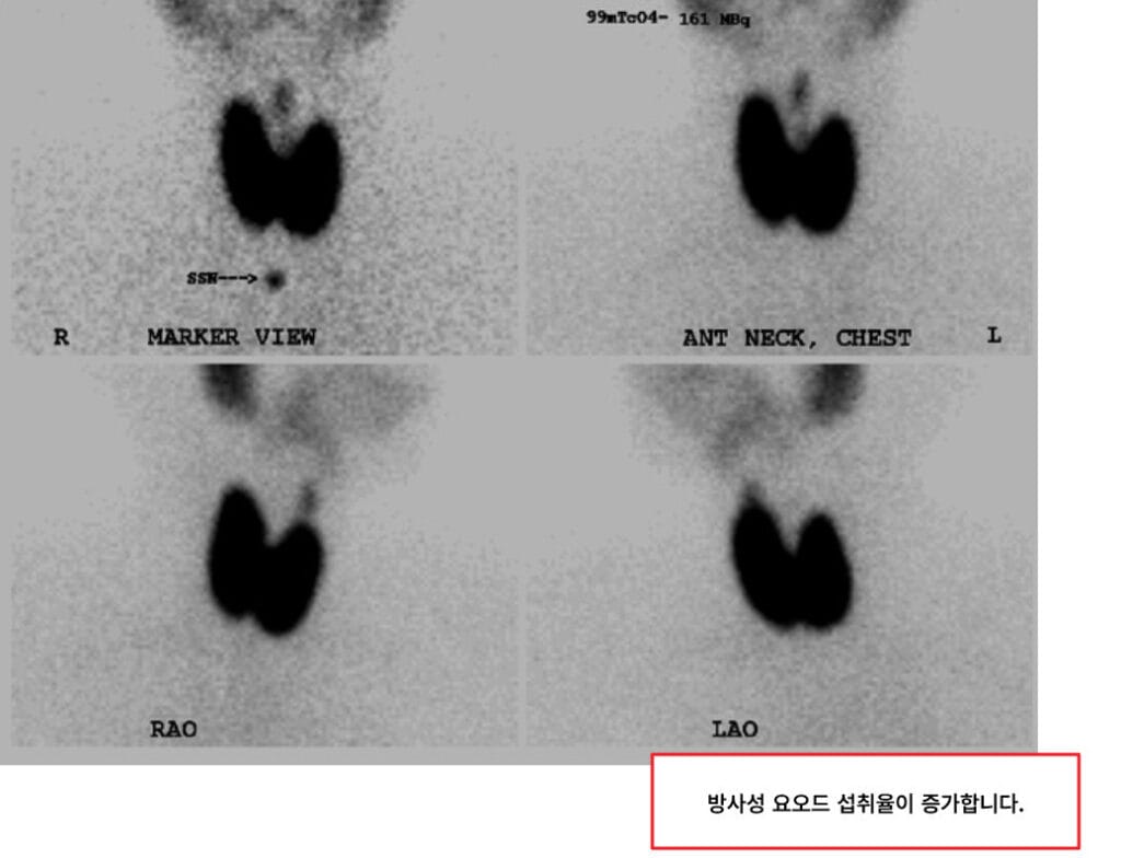 Graves' Disease