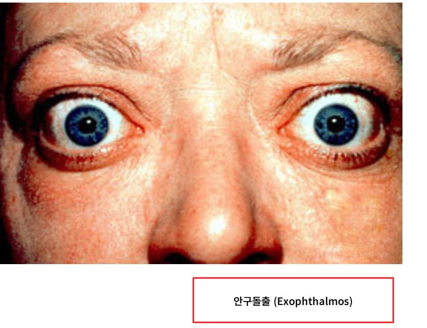 Graves' Disease