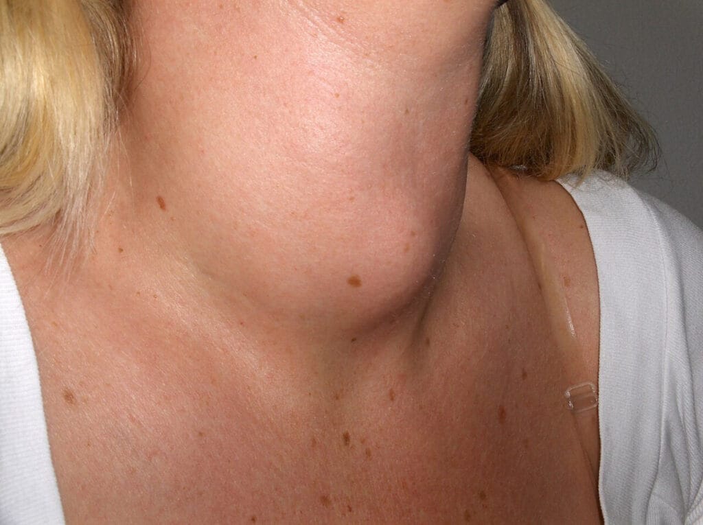 Graves' Disease