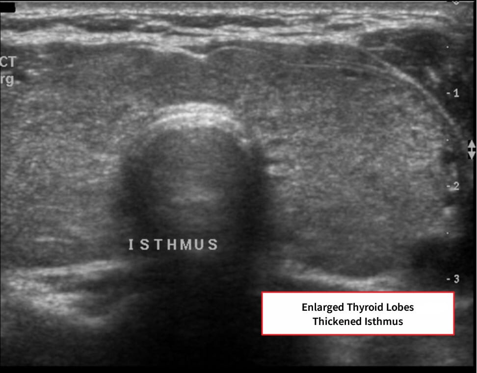 Graves' Disease