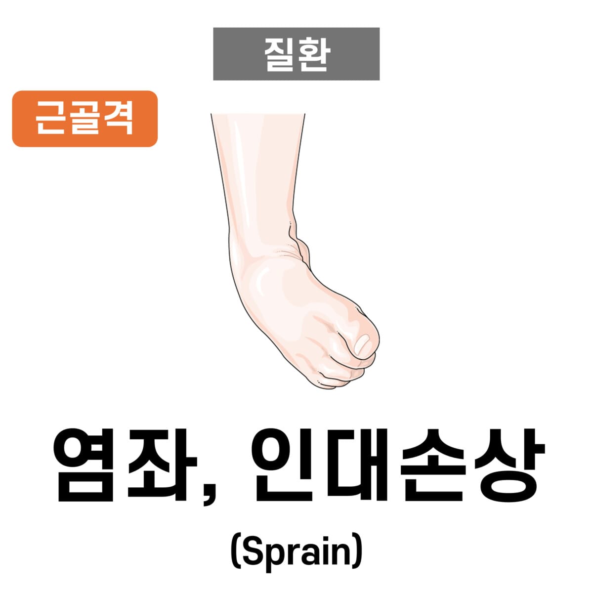 Sprain, 염좌