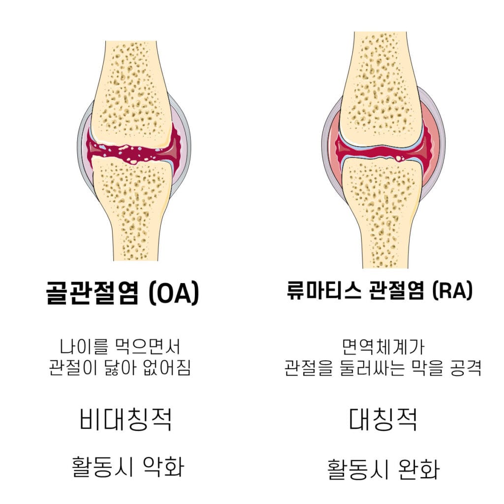 arthritis - degenrative vs inflammatory