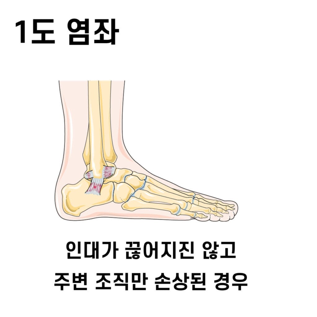 Sprain, 염좌
