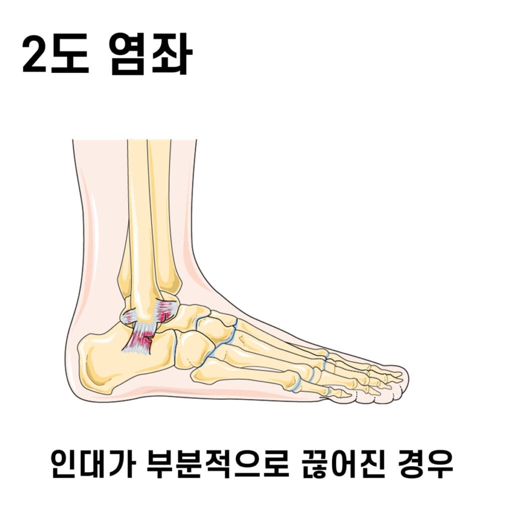 Sprain, 염좌