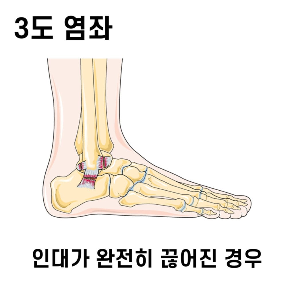 Sprain, 염좌