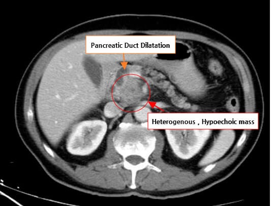 Pancreatic Cancer