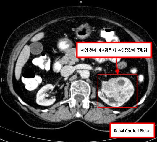 Renal Cell Carcinoma