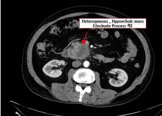 Pancreatic Cancer
