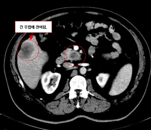 Pancreatic Cancer