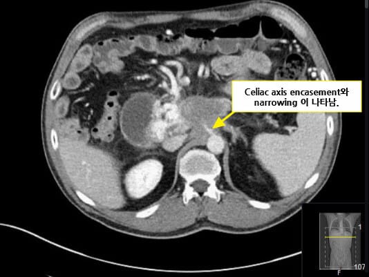 Pancreatic Cancer