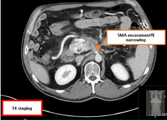 Pancreatic Cancer