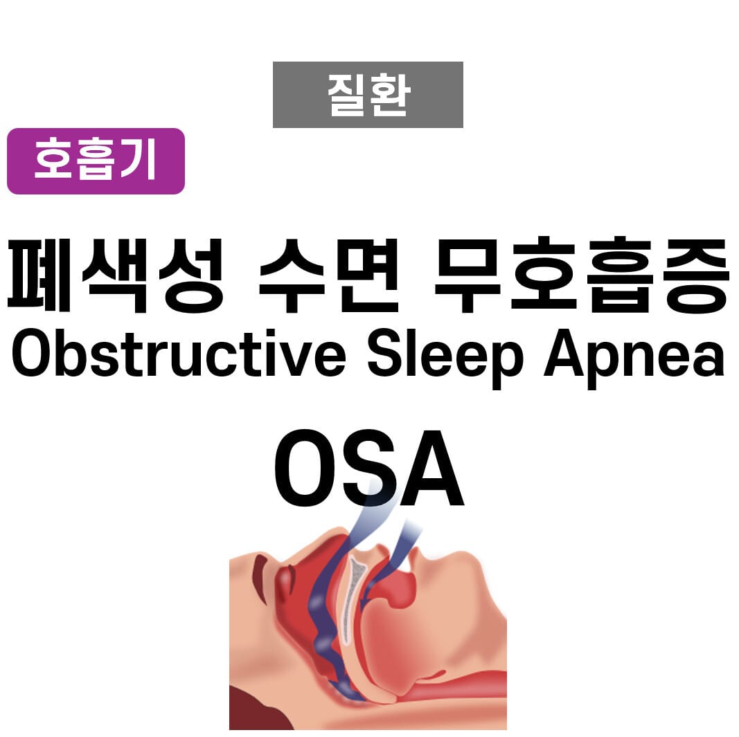 폐색성 수면 무호흡증 (Obstructive Sleep Apnea)