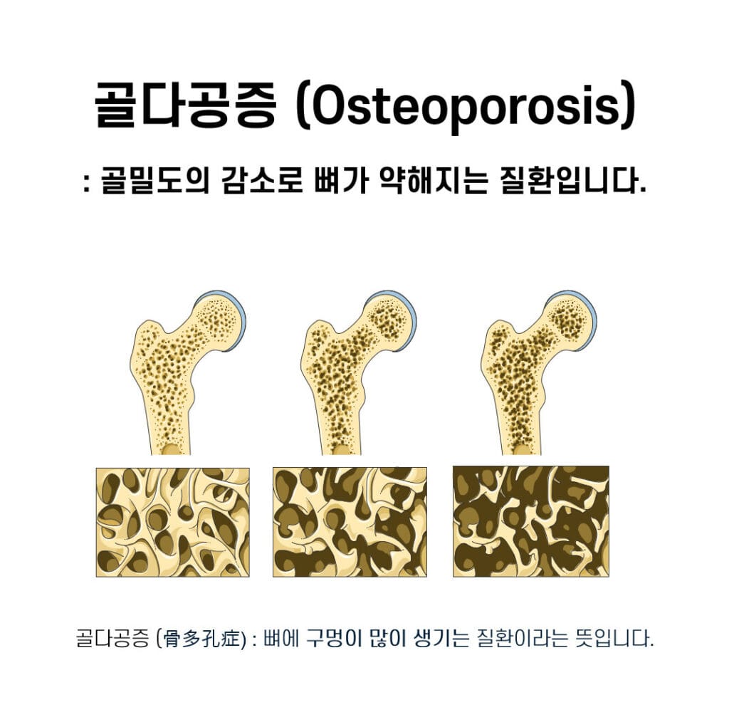 Osteoporosis