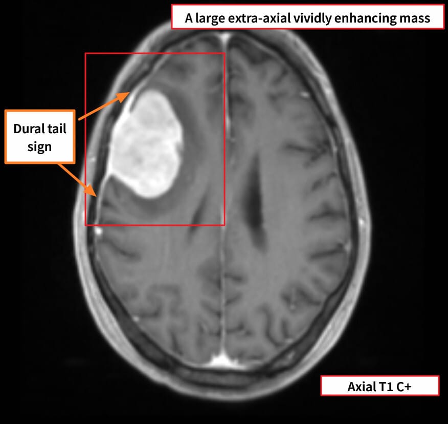 Meningioma