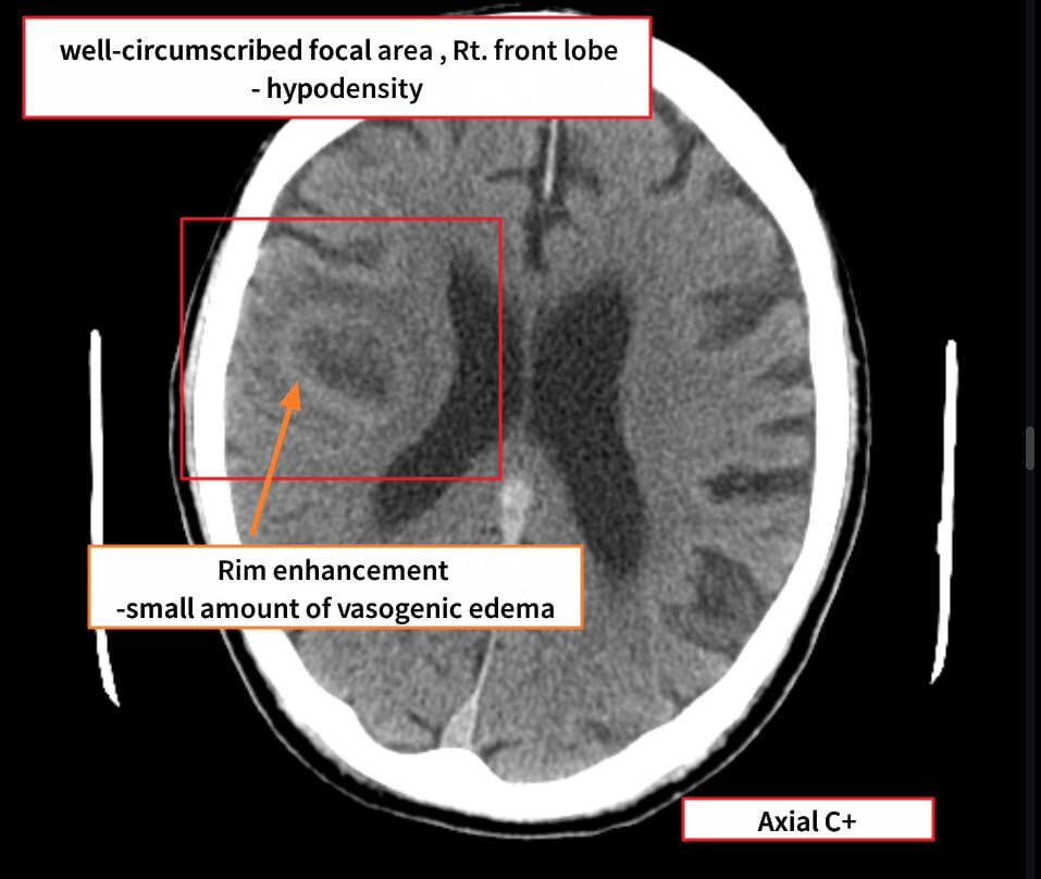 glioblastoma