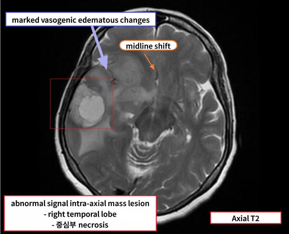 glioblastoma