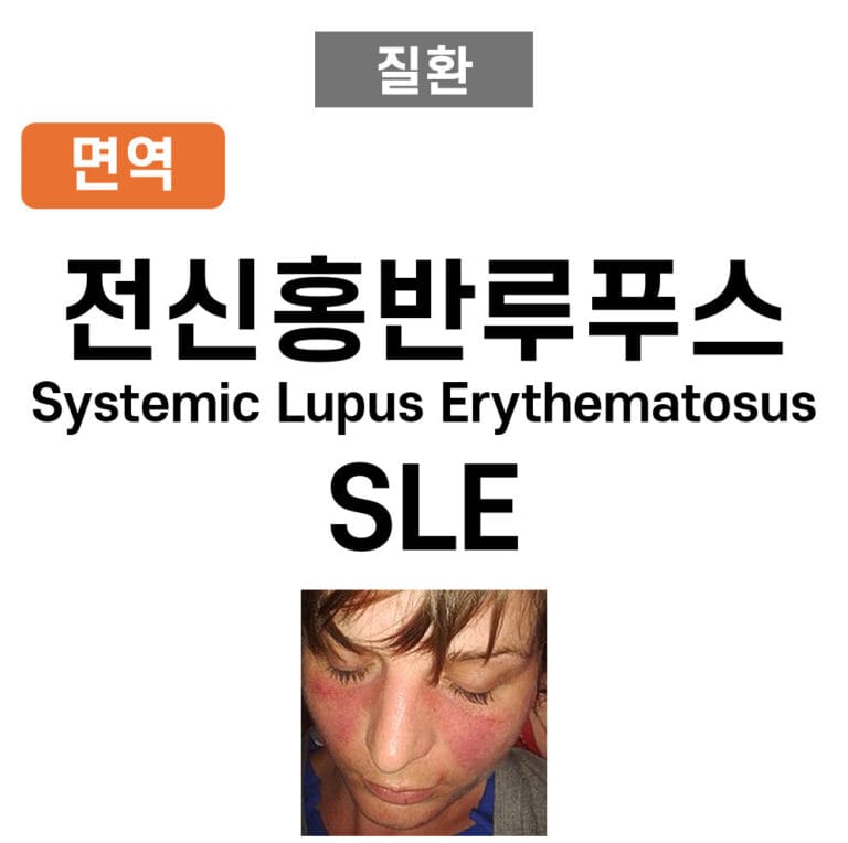 전신홍반루푸스 (Systemic Lupus Erythematosus, SLE)