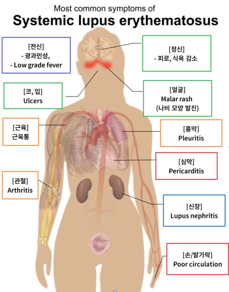 Systemic Lupus Erythematosus, SLE
